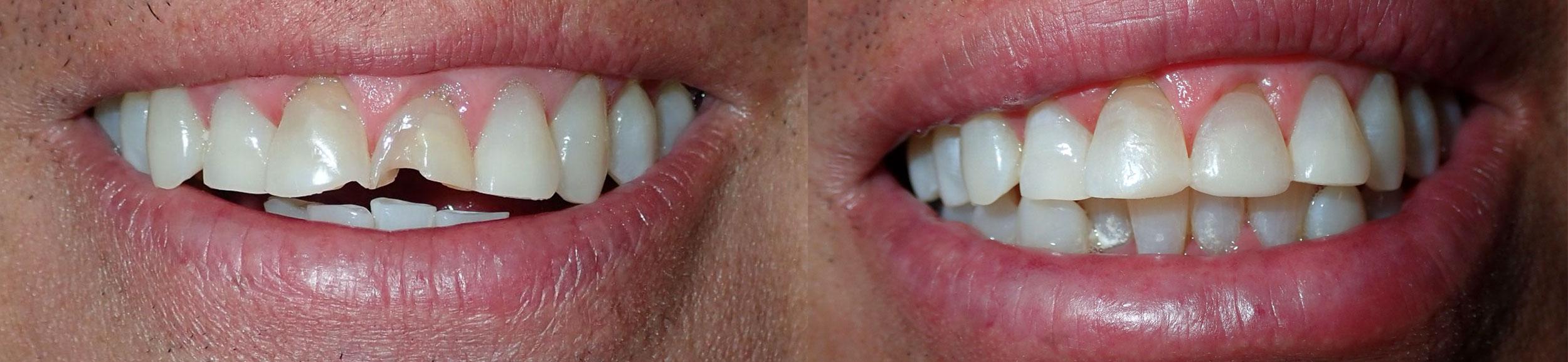 Dentist uses composite fillings to fix chips in Castro Valley