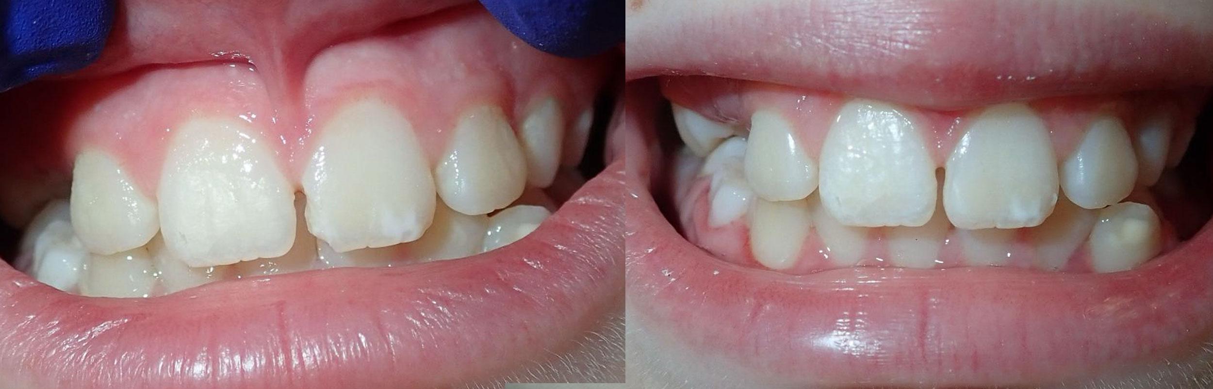 Child with composite fillings to fix chip