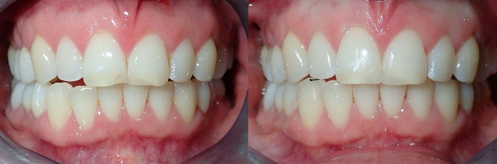 Dental solutions to fix chipped teeth in Castro Valley