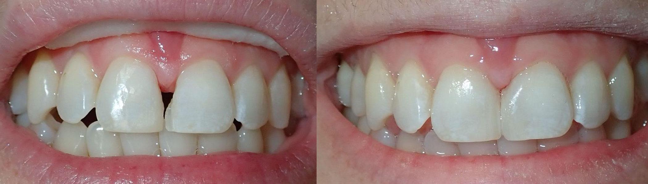 Composite fillings to close diastema gap in teeth