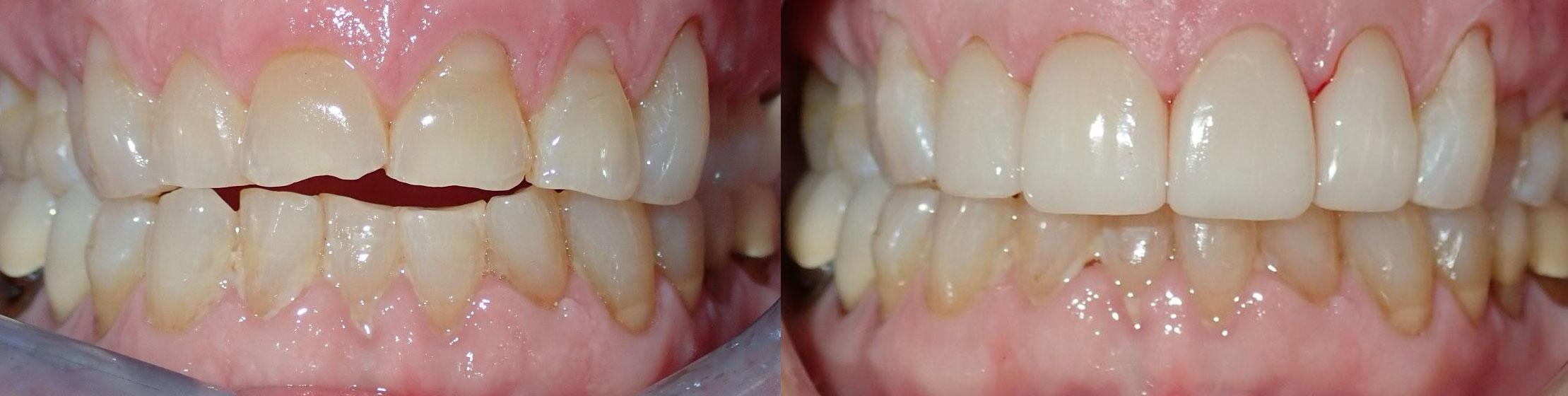 Cosmetic crowns to repair damaged dentition